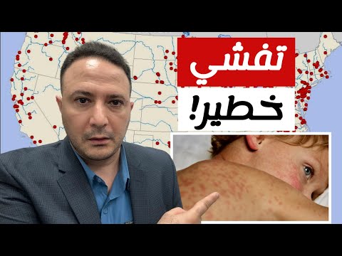 ⚠️🔥 انتشار الحصبة في أمريكا بعد اختفائها.. هل نحن أمام وباء جديد؟