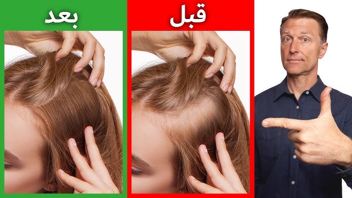 12 وَصْفَةً طَبِيعِيَّةً لِلتَّخَلُّصِ مِنْ تَسَاقُطِ الشَّعْرِ وَجَعْلِهِ قَوِيًّا وَجَمِيلًا